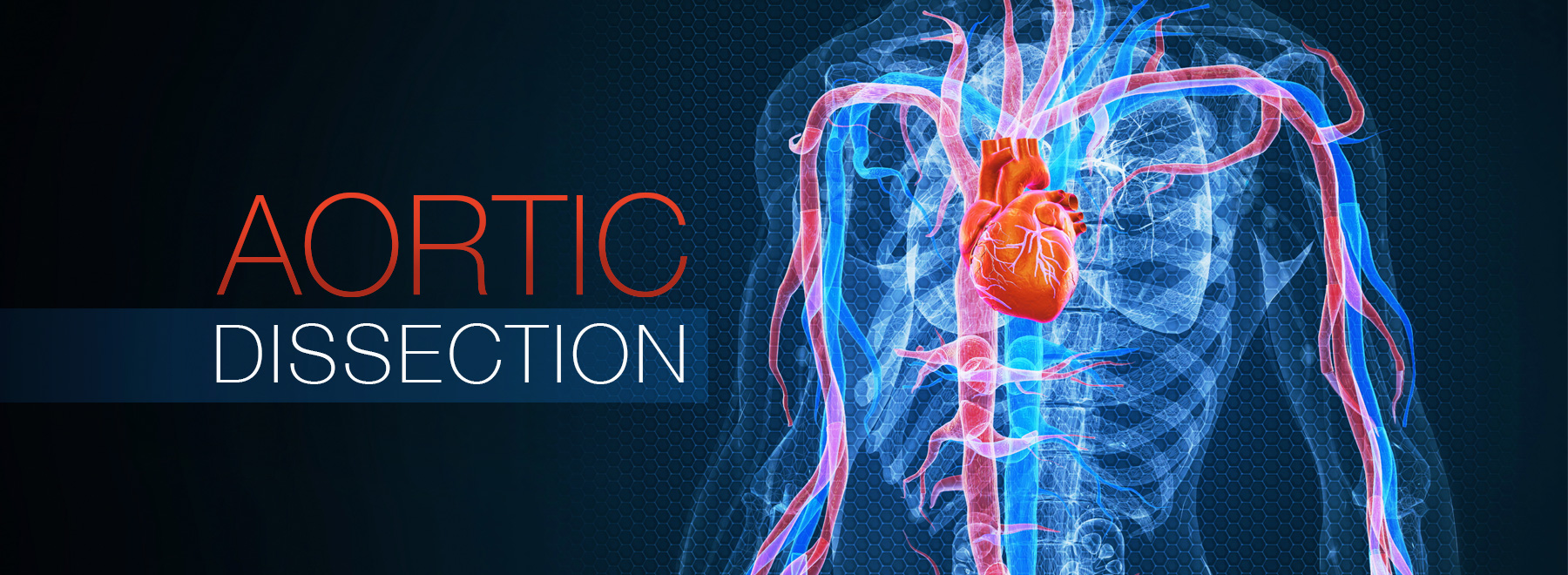 Body scan image featuring the heart and vascular system, specifically depicting an aortic dissection for medical analysis.
